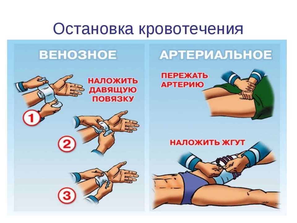 ДОВРАЧЕБНАЯ (ПЕРВАЯ) ПОМОЩЬ ПРИ КРОВОТЕЧЕНИЯХ